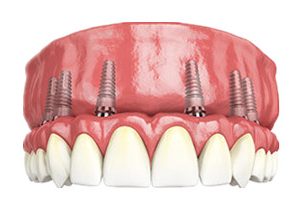 A close up of a set of teeth with implants