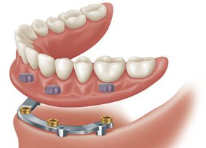 A close up of an implant retained denture