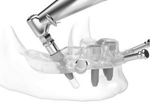 A dental implant being placed into the lower jaw of a patient.