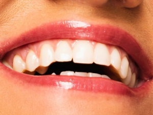 A close up of the teeth and smile of a woman